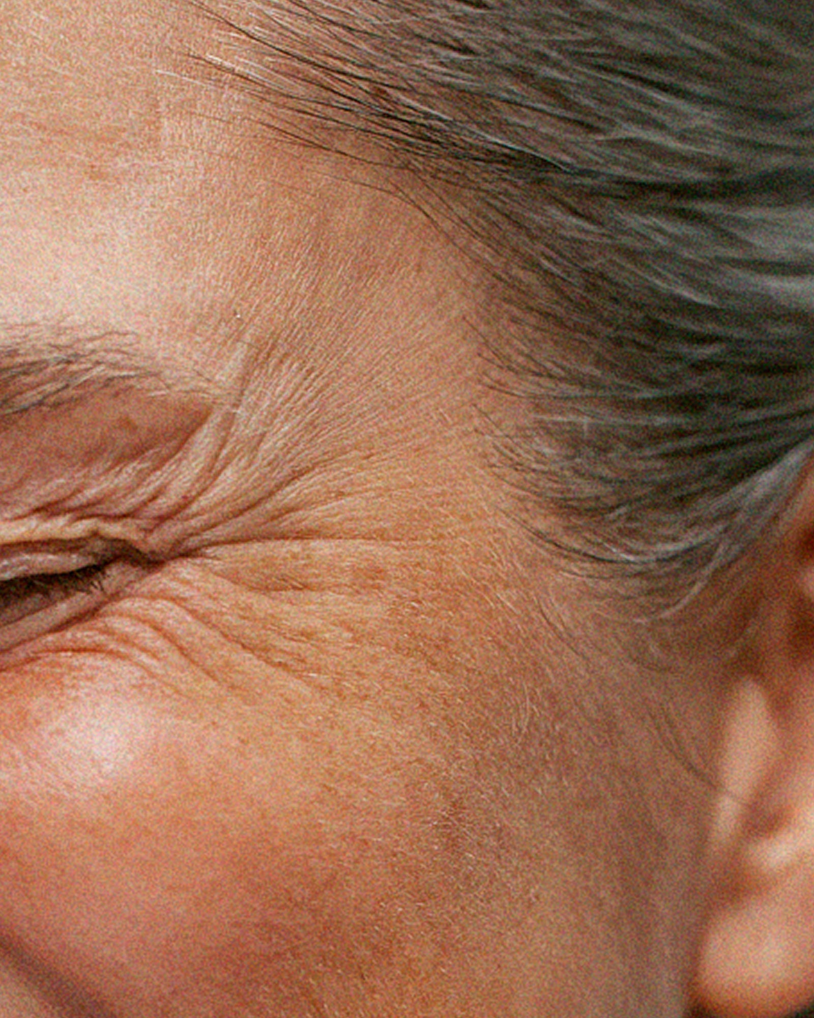 Fine lines and wrinkles